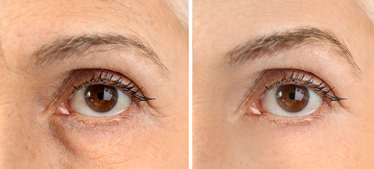 blepharoplastie tunisie